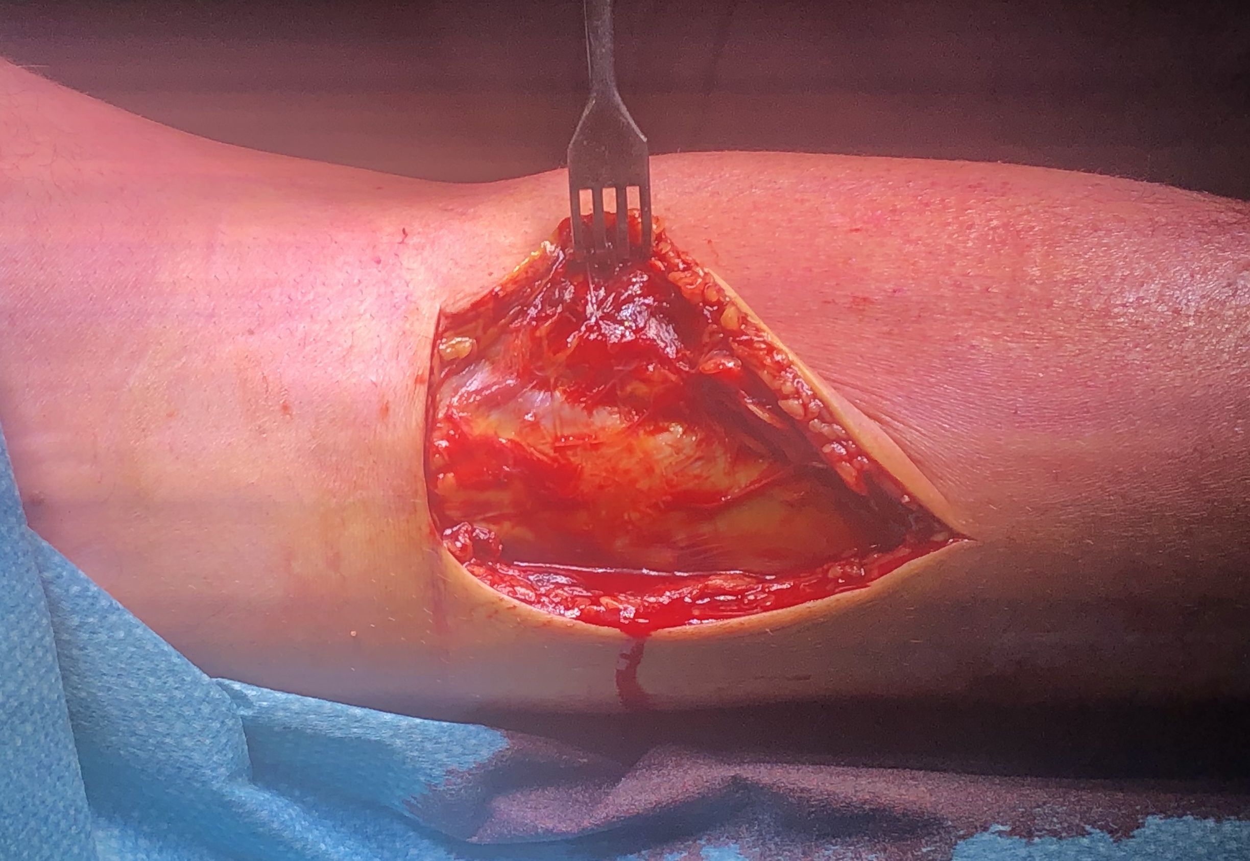 Posteromedial approach knee 1